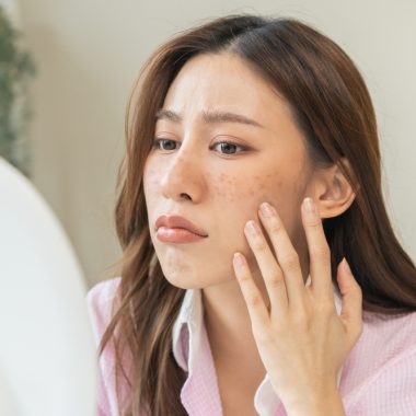 Mengenal Berbagai Macam Jerawat dan Cara Mengatasi